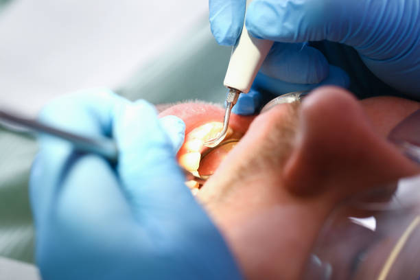 Best Broken or Chipped Tooth Repair in Mccordsville, IN
